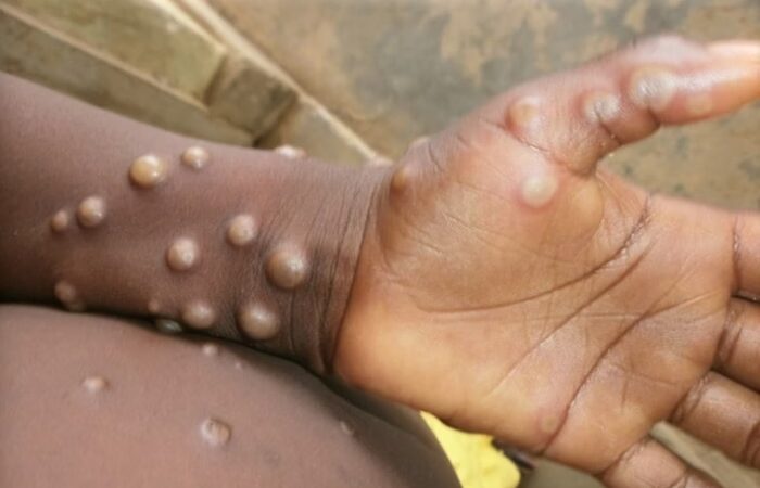 São Paulo registra 33 novos casos de Mpox em 15 dias