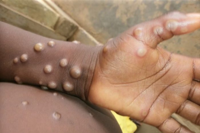 São Paulo registra 33 novos casos de Mpox em 15 dias